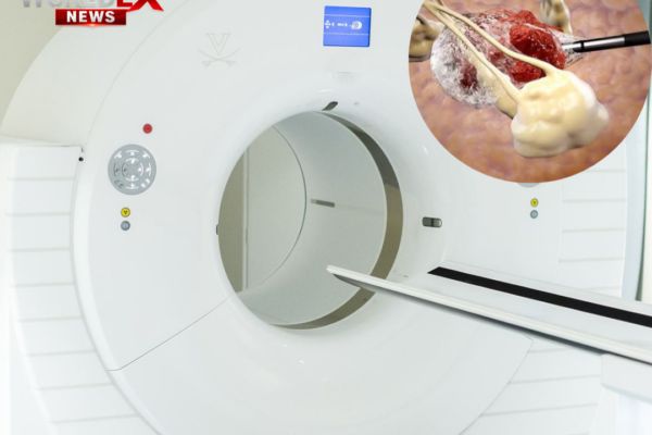 Australia Introduces Treatment That Freezes and Destroys Tumors Without Surgery